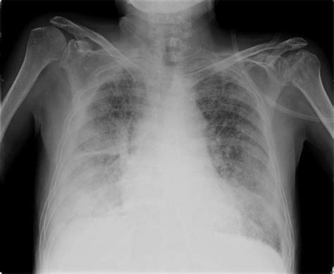 Crohns Disease With Severe Lung Involvement Archivos De Bronconeumología