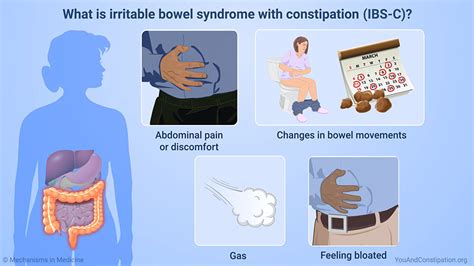 Slide Show Managing And Treating Ibs With Constipation