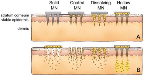 The Four Different Types Of Microneedles As Discussed In This Paper A