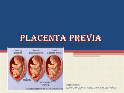 Placenta Previa Vasa Previa