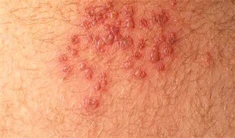 Acute Hiv Rash Chest