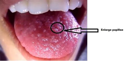 Circumvallate Papillae Definition Enlarged Causes Treatment Symptom