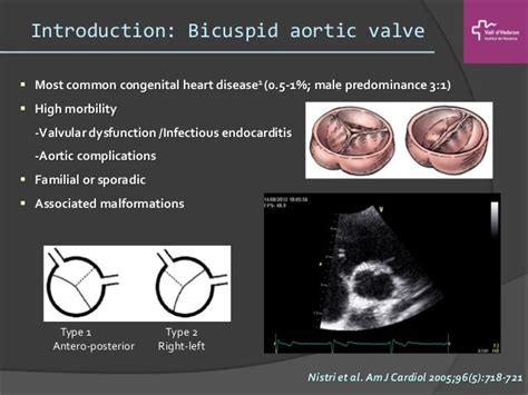 Familial aggregation of bicuspid aortic valve: is it useful a family