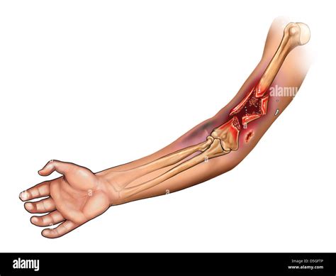 Radius ulna comminuted fracture hi-res stock photography and images - Alamy