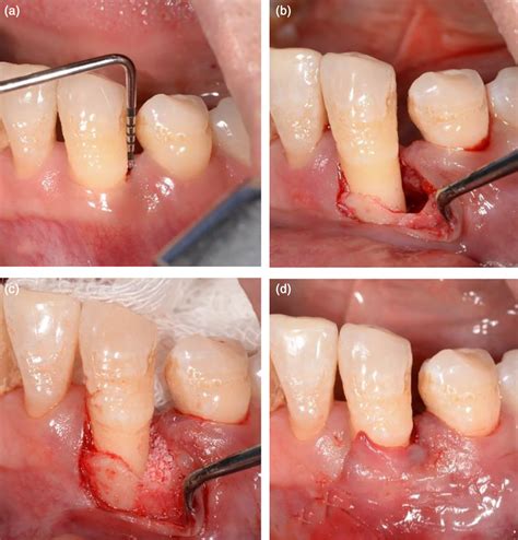 The Entire Papilla Preservation Epp Technique A Preoperation B