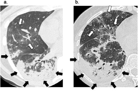 Antisynthetase Syndrome Pulmonary Computed Tomography Findings Of Adult Patients With