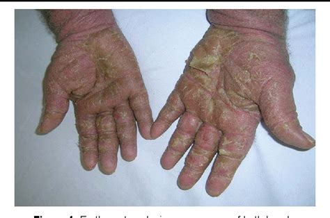 Figure From Drug Rash With Eosinophilia And Systemic Symptoms