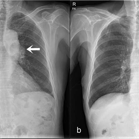 A Chest X‐ray Shows A Bulging Contoured Lesion In The Left Hilum And Download Scientific