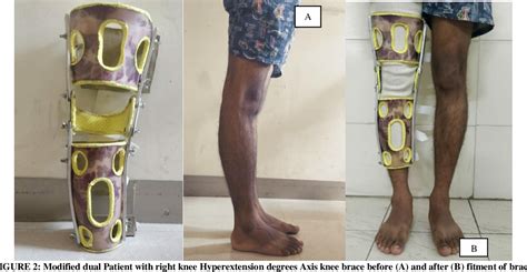 Pdf Effectiveness Of Modified Dual Axis Knee Brace In Case Of Genu