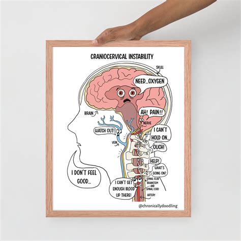 Craniocervical Instability CCI Funny Cartoon Framed Photo Paper Poster
