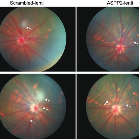 ASPP2 Upregulation Affected The Retinal Morphology In Experimental Rat