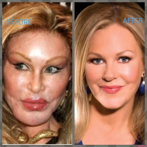 Lis Wiehl Plastic Surgery Photos [Before & After] ⋆ Surgery4