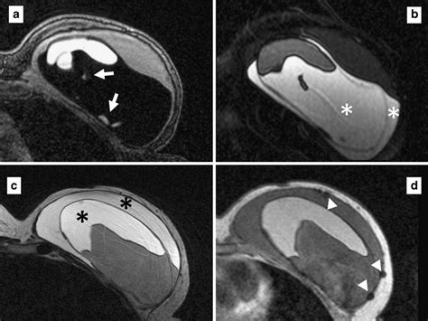 Mri Of A Year Old Woman With A Ruptured Breast Implant Confirmed At