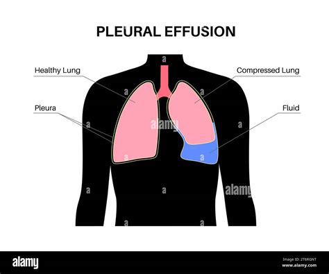 Pleural Effusion Illustration Stock Photo Alamy