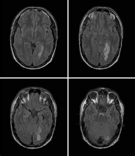 Occipital Lobe Stroke