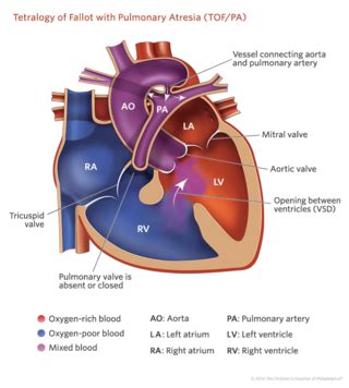 Pulmonary Atresia | Children's Hospital of Philadelphia