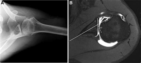 posterior glenoid bone loss  instability  evidence bas jaaos