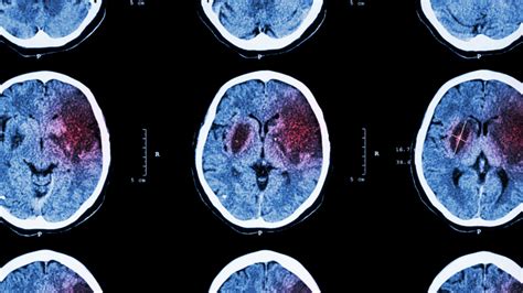 If Stroke Strikes Will You Be Ready MemorialCare