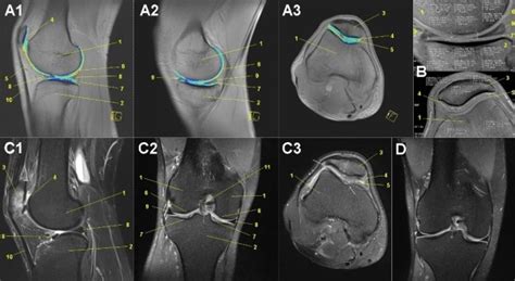 Mobile MRI of the knees. Femoral condyle (1), tibial head (2), patella...