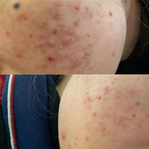 Face acne - about 5 years first caused by stress - rosehip oil and ...