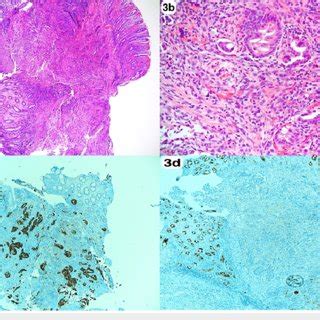 Histopathology Of Colonic Lesion A B Sigmoid Colon Biopsy Colonic