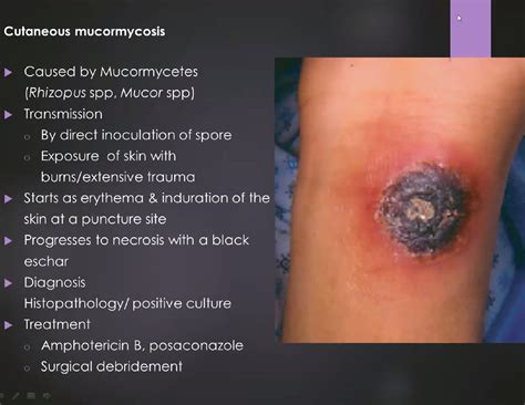 SOLUTION Cutaneous Subcutaneous Mycoses Micro Dr Ambalavanar 13 07