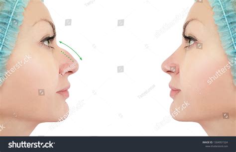 Woman Nose Correction Before After Procedures Stock Photo 1304951524