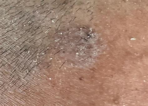 Spot On Scalp 3 Photo Of The Same Spot What Is It Rdermatologyquestions