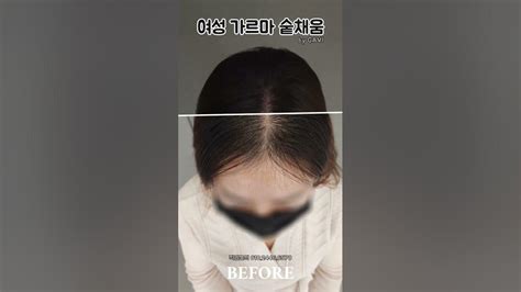 📸사진찍을때도 당당하게~ ️ ️여성 가르마 숱채움 가르마밀도보강 디블랙부산 가르마숱채움 밀도보강 두피문신 부전탈모커버