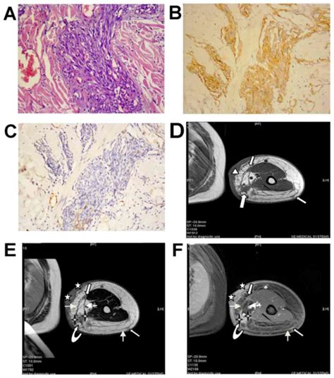 Stewart‑treves Syndrome Magnetic Resonance Imaging Data Compared With