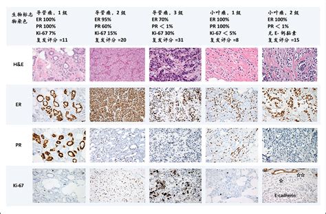 雌激素受体阳性、her2阴性乳腺癌的全身性治疗 Nejm医学前沿