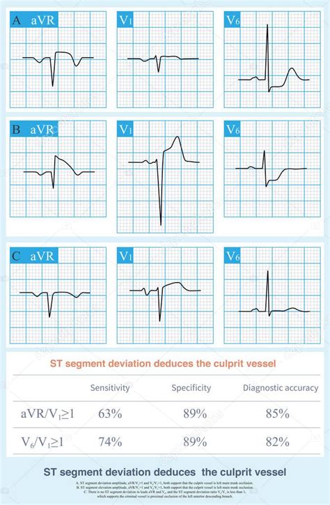 En El Ecg En Caso De Infarto Agudo De Miocardio La Amplitud De