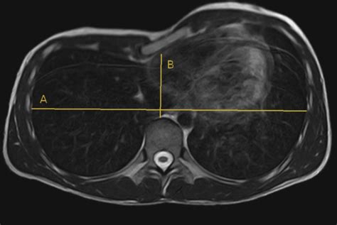 Funnel chest deformity