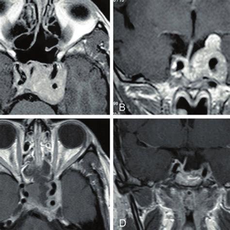 Preoperative Contrast Enhanced T1 Weighted MRI Scan In Coronal A