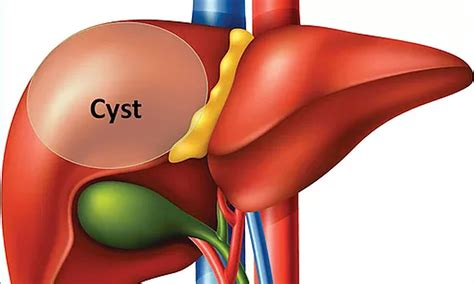 NONSURGICAL TREATMENT OF BENIGN CYSTS