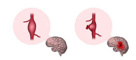 Brain Aneurysm What It Is Causes Symptoms Treatment 41 Off