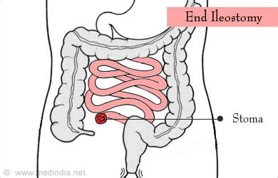 Ileostomy Types Tests Required Benefits And Risks