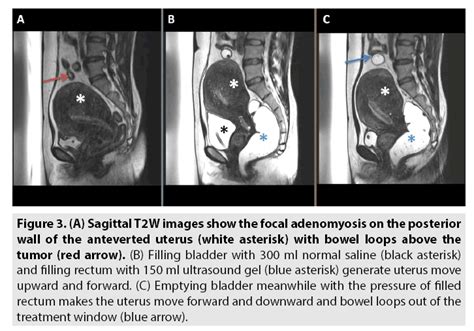 Focal Adenomyosis Ultrasound