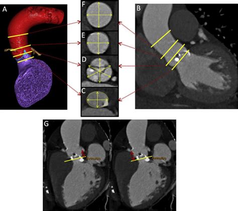 Sex Differences In Aortic Root And Vascular Anatomy In Patients