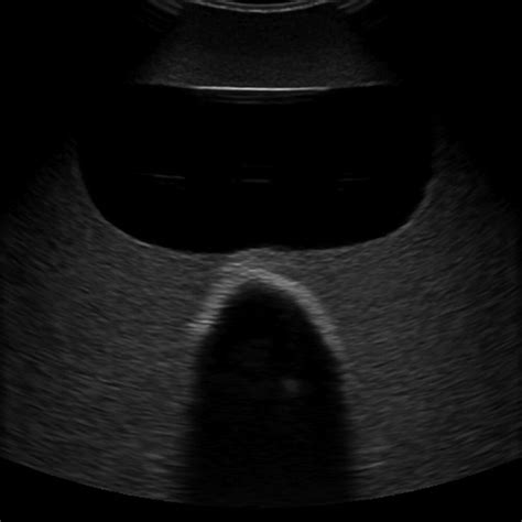 Rectal And Bladder Ultrasound Phantom KYOTO KAGAKU