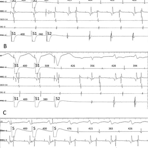 Differential Atrial Entrainment Pacing At An S S Cycle Length Of 365 Ms