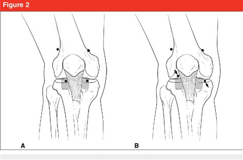 Figure From Arthroscopic Releases For Arthrofibrosis Of The Knee