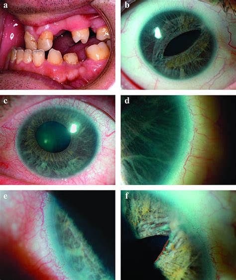 Axenfeld Anomaly Is Seen In Glaucoma Associated With Mcq