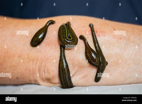 Leech On Arm Hi Res Stock Photography And Images Alamy