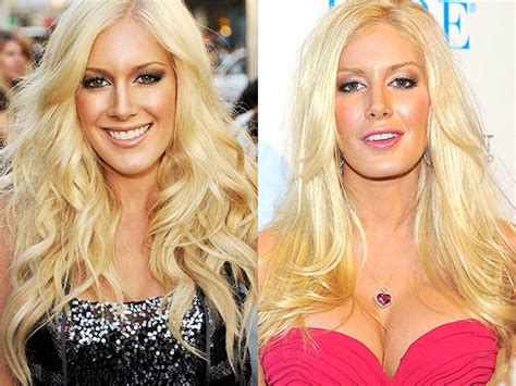 Heidi Montag Celebrity Plastic Surgery Disasters Cbs News