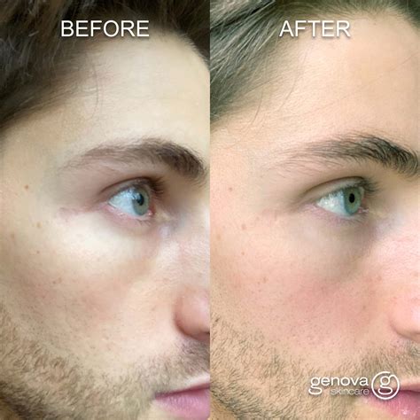 C-Section Scar Healing: Types, Care and Tips for Minimising Scars