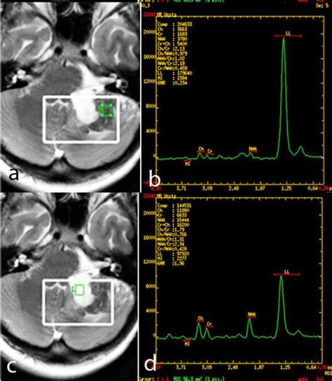 Imaging Findings Of An Epidermoid Cyst Undergoing Malignant