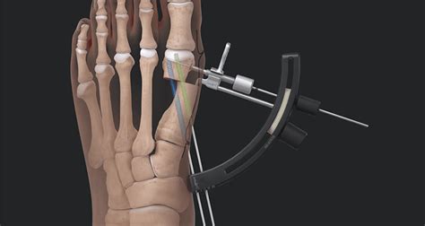 Arthrex Minimally Invasive Bunionectomy System Is Launched