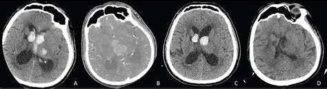 Intraparenchymal Hemorrhage Vs Subarachnoid Hemorrhage