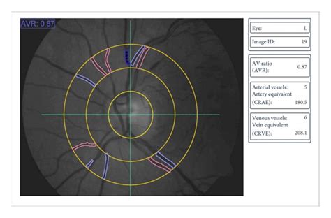 Impact Of Intravitreal Dexamethasone Implant On Vessel Diameters In